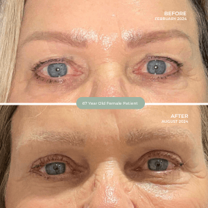 67 Year Old Female Patient